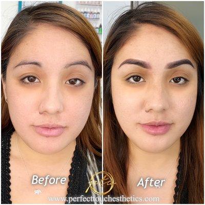 Transformation after Combo Brow Procedure