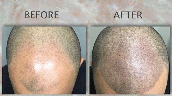 Scalp Micro-pigmentation