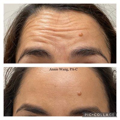 Forehead wrinkle treatment with neurotoxins