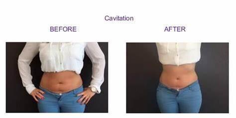 Let's get the results you want in 4 weeks . Non-invasive and painless results