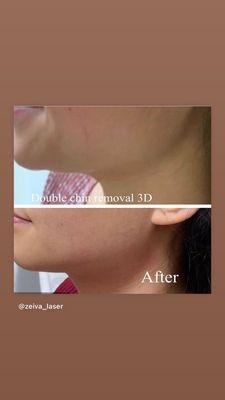 Double chin fat reduction (Trusculpt 3D)