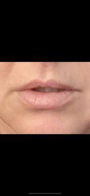 Before lip filler