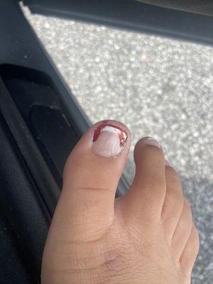 Bloody nail :(