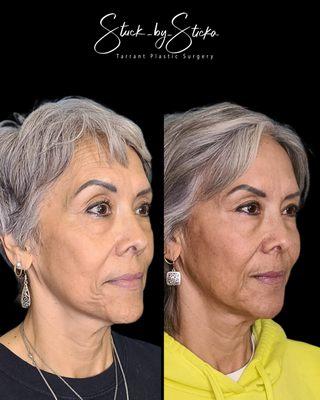 Full face rejuvenation with Botox and Juvederm Filler