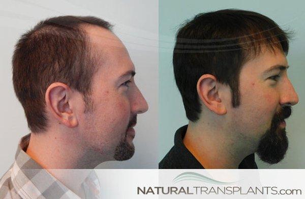 hair transplant results