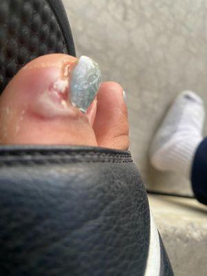 Infected toe