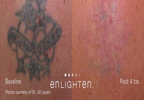 Laser Tattoo Removal NYC - Before & After