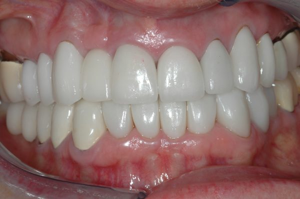 Case.A-After by e.max veneers