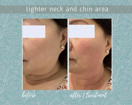 ULTHERAPY Skin tightening