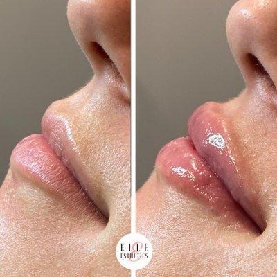 Lip Filler