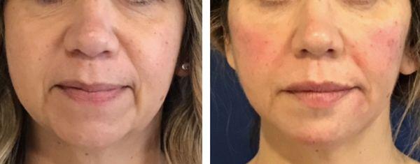 Before and After Restylane filler injection