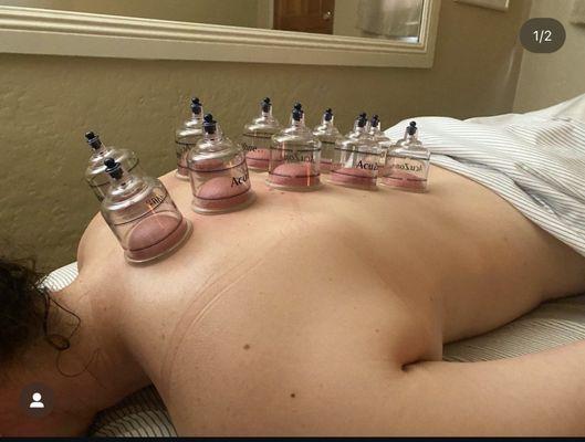 Cupping on the back