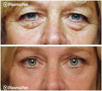 Plasm Pen Ultimate Eyes No-Surgery Eyelift 409-454-9502