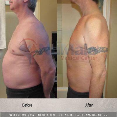 Medical Weight Loss for Men. Before and After. NuMale Medical Center