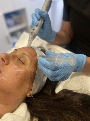 PRP Facial