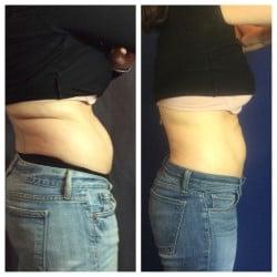 Our patient Before & After Sculpsure treatment