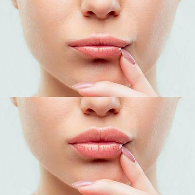 Juvederm Injections
 Russian Lip