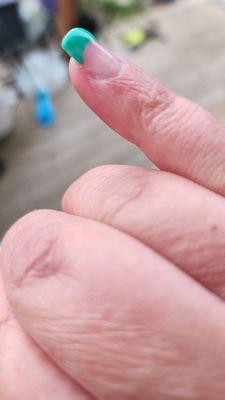 Raw skin above cuticle