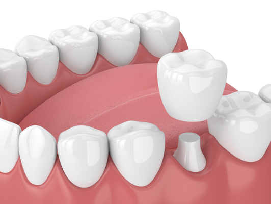 Porcelain dental crowns are a great option for teeth restoration. They resemble and function as natural teeth while restoring...