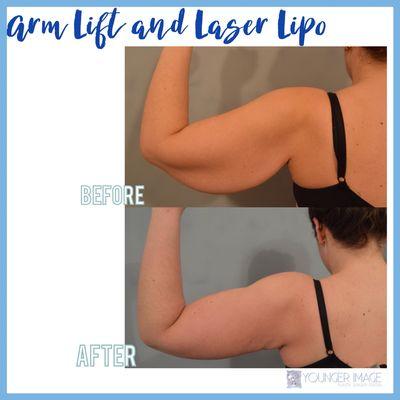 Arm Lift Procedure