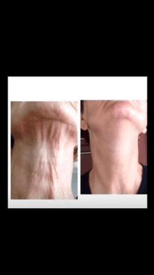 Terrific results for Crepe Skin on Neck with Opus Plasma Device!