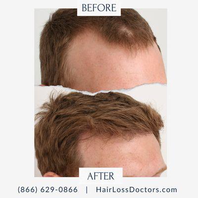 Male Before / After Sample from The Hair Loss Doctors By Robert J. Dorin with Surgical Headquarters in Garden City, NY.