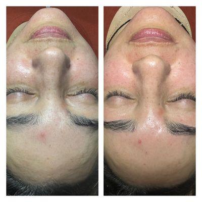 Before and after: a customized facial with a dermaplane and happy peel treatment