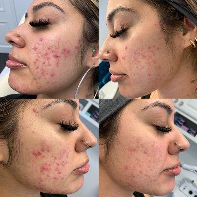 Five weeks of customized skin care program