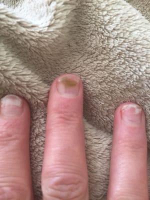 Nail fungus