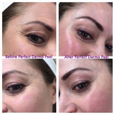 1 Perfect Derma Peel. Stunning results!!