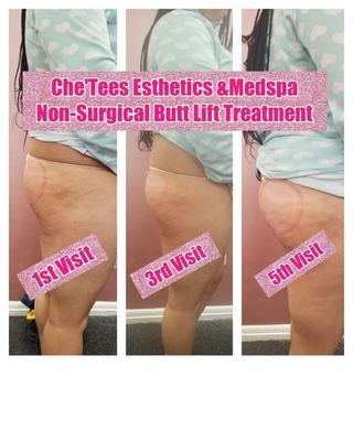 Body Contouring/Non-Surgical Butt Lift