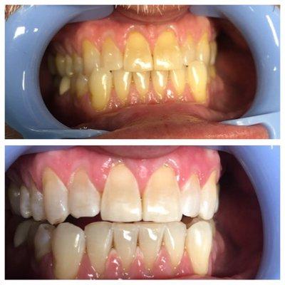 Big stain difference!! Teeth don't have to be fake to look better.