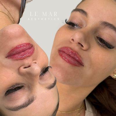 Lip Filler