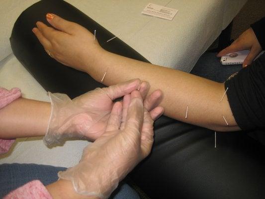 Dry needling (trigger point therapy) on the arm and wrist.