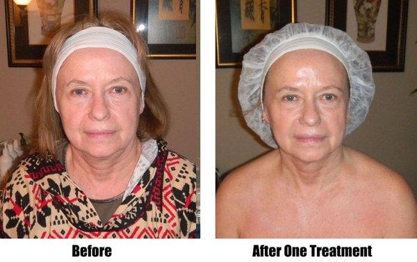 One microcurrent facial treatment before and after