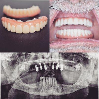 All-On-Six(six implants supported full zirconia restoration)