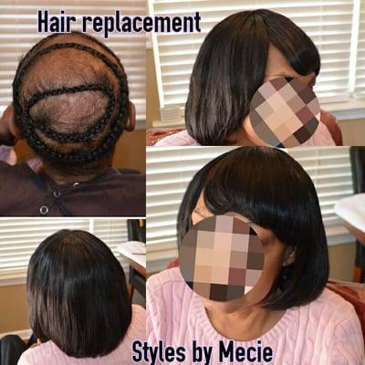 Hair Replacement/ Hair loss Solution