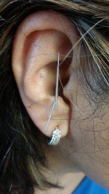 Ear Acupuncture for pain relief