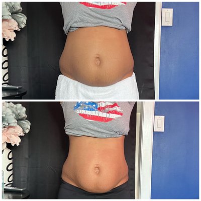 First session of body contouring