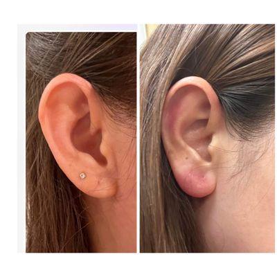 Rejuvenate the earlobe using filler