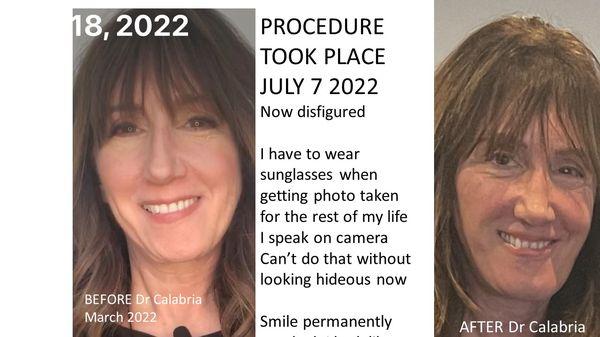 Facial Plastic surgery. I now have to wear sunglasses my face  looks distorted . Client review. Dr Renato Calabria, Beverly Hills CA