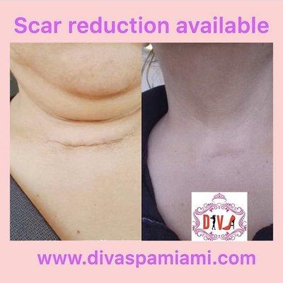 Scar reduction treatment