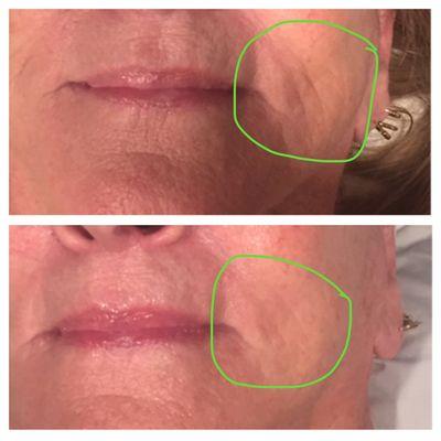 Client received one microcurrent treatment!