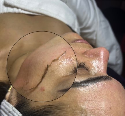 Dermaplane Facial