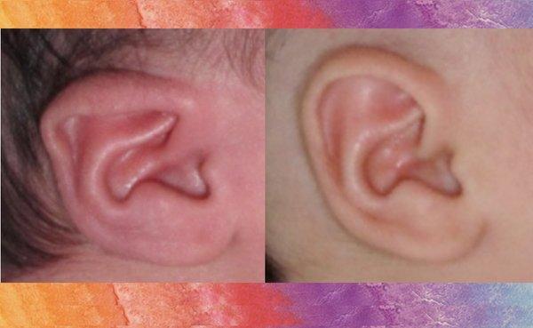 Infant Ear Molding (Ear Well) Before & After - non surgical treatment