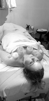 Cupping uses negative pressure to draw out stagnant fluids to the surface allowing fresh blood to circulate.