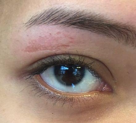 They waxed the skin off. It burns and I am pretty sure this does not look normal. I just wanted an eyebrow wax..