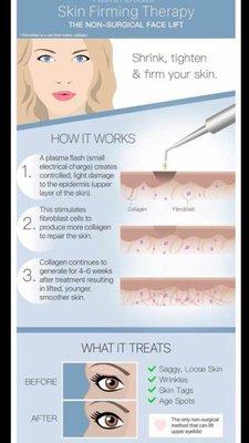 How plasma fibroblast works!