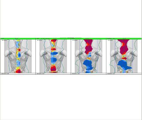 Performing daily nerve analysis on ever visit to ensure your body is healing at it's best!