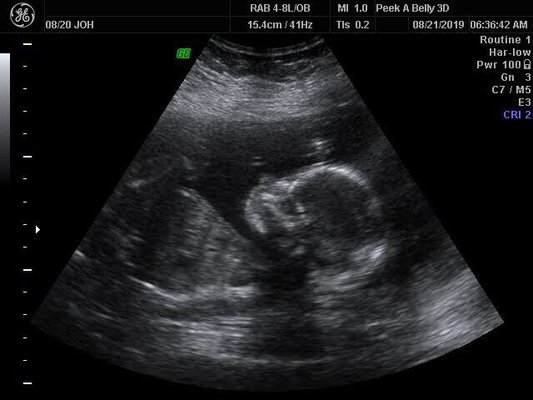 20 week ultrasound.